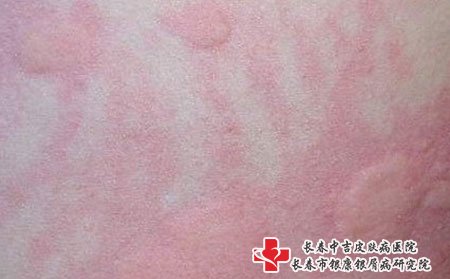 女性荨麻疹常识,女性荨麻疹能怀孕吗