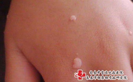 扁平疣要注意不要用手使劲抓挠，以防感染