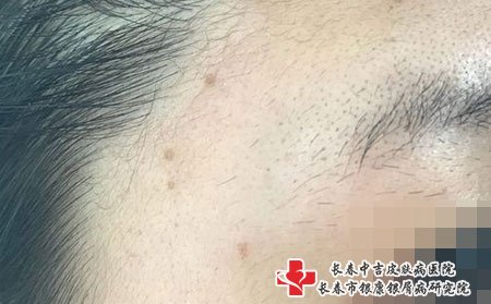 扁平疣喝脂肪粒区别有四点，原因不同，外形不一样，生长速度不一样