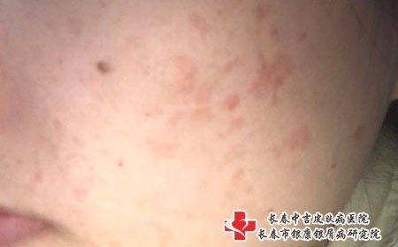 扁平疣经常长在青少年人群，要经常锻炼身体，增加免疫力