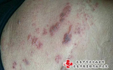 带状疱疹会引起并发症，要及时治疗