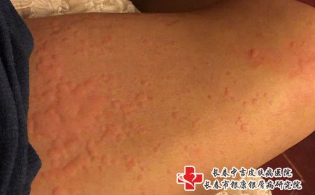 皮肤瘙痒和水痘是有区别的，了解清楚病因