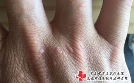 扁平疣在手上，可以激光或者物理治疗