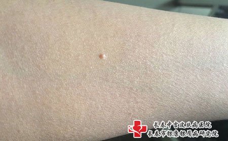 扁平疣和我梅毒不一样，要注意区分