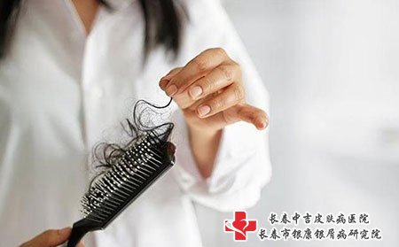 长春银康银屑病专科：牛皮癣疾病的相关类型