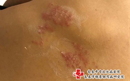 带状疱疹的水泡不要自己能破，会感染