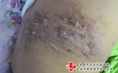 长春医院治疗疱疹的医院又很多，患者要选择正规的医院