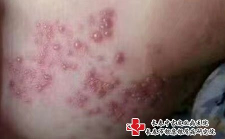 带状疱疹要注意，不要用手抓挠