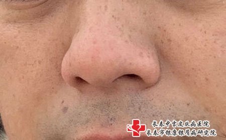 雀斑要注意防晒