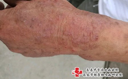 出现皮肤瘙痒要及时去医院检查