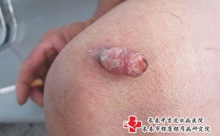 这是寻常疣