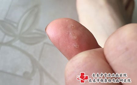 扁平疣有传染的可能性，要注意