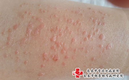 板蓝根对于扁平疣作用不大