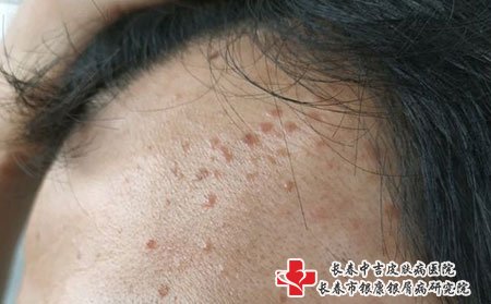 治疗扁平疣可以选择长春中吉皮肤病医院