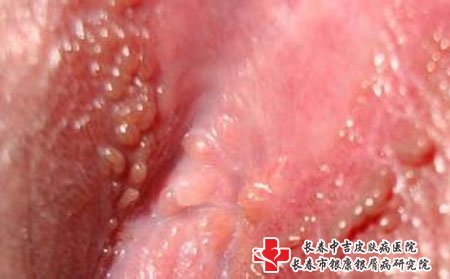 带状疱疹尽量少吃肥肉
