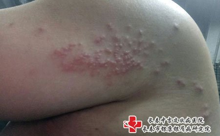 带状疱疹好了痛是因为后遗症，需要继续涂药