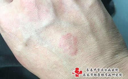 荨麻疹来也快，去也快