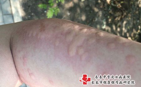 荨麻疹要选择正规医院
