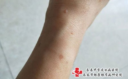 扁平疣属于传染性病