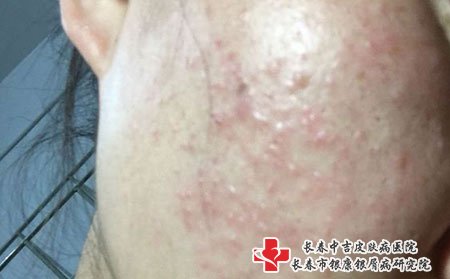 扁平疣要做好护理