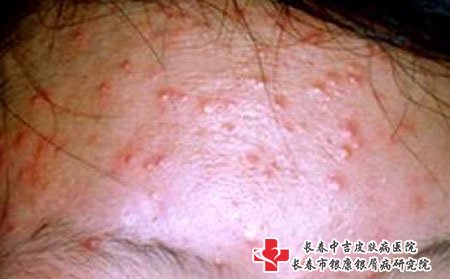 青春期的男生女生比较容易长痤疮