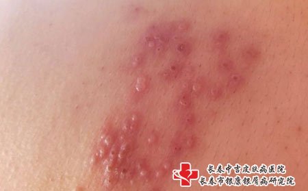 带状疱疹要及时治疗
