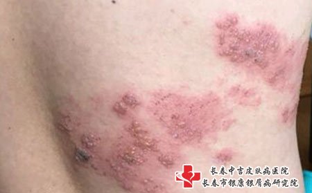 带状疱疹饮食方面要注意
