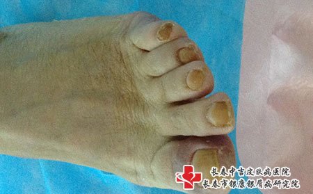 湿疹也可能会不痒