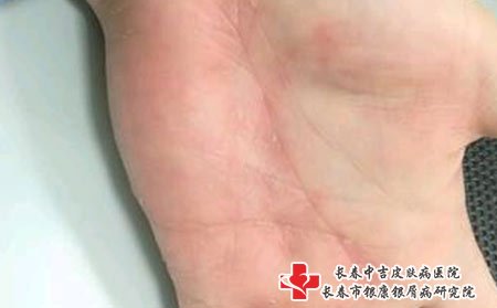 皮肤瘙痒主要原因是病毒性感染