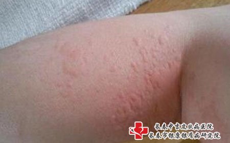 皮肤瘙痒可能会引起一系列并发症