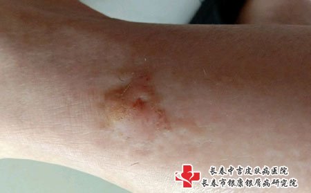 湿气重会引起皮肤瘙痒