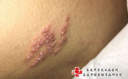 带状疱疹要注意卫生