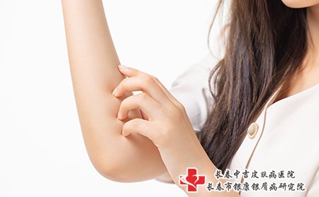 带状疱疹不要用手抓挠皮肤