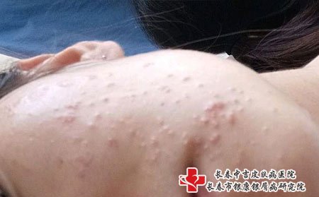 扁平疣和二期梅毒不一样