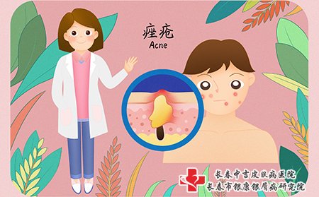 痤疮患者要多喝水