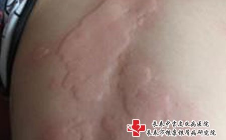 皮肤瘙痒可能是皮肤过敏