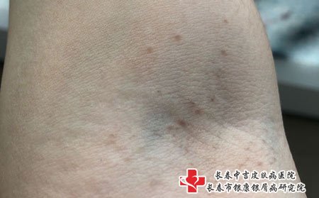 扁平疣有一定传染性
