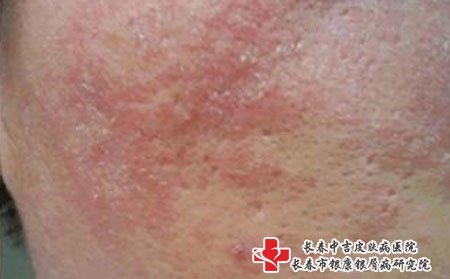皮肤瘙痒图片