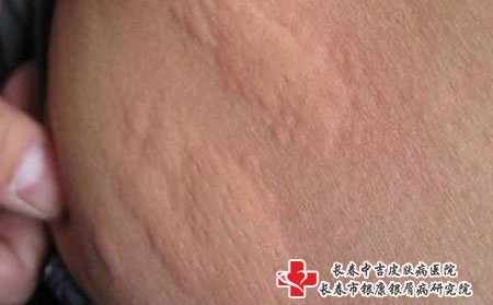 荨麻疹图片