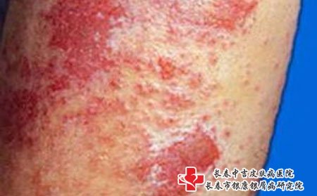 寒冷性荨麻疹分两种
