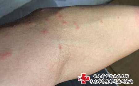 皮肤瘙痒要注意用药