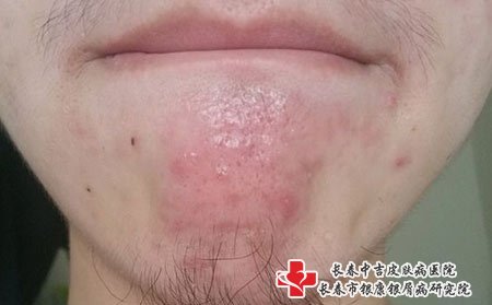 痤疮治疗有四种方法