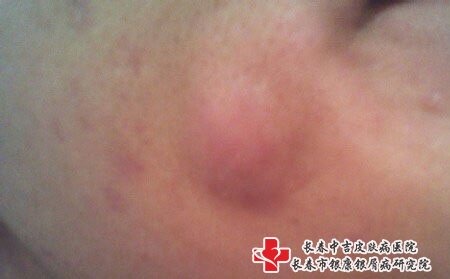 不要用手挤痘痘