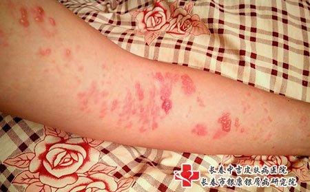 带状疱疹会引发严重并发症