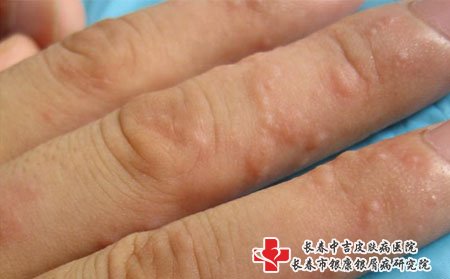 皮肤瘙痒是真菌感染引起