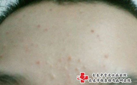 痤疮可能是饮食不规律
