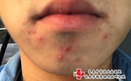 脸上长痘痘可可能是新陈代谢慢