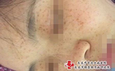 激光治疗雀斑要选择正规医院