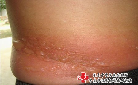 带状疱疹要注意护理