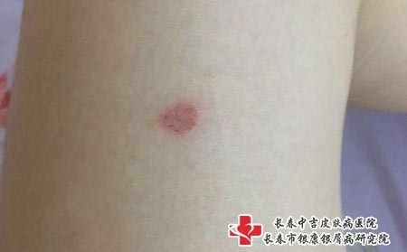 皮肤瘙痒图片